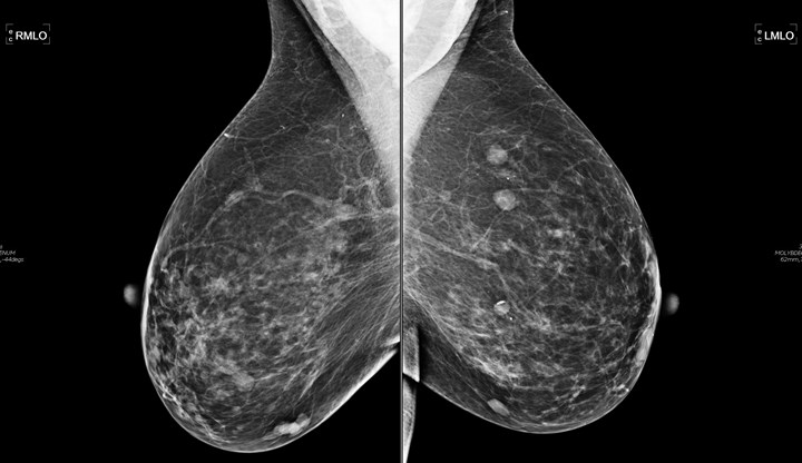 Really. And images of segmental breast calcifications seems This images of segmental breast calcifications consider